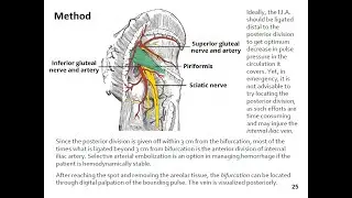 EXTERNAL LIGATION OF THE INTERNAL ILIAC ARTERY (E.L.I.I.A.)- by Naira (surgeon, jurist)