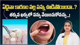ప్రెసిషన్ అటాచ్&zwnj;మెంట్ అంటే ఏమిటి? | What Is a Precision Attachment in Dentistry? | Oxy Dental