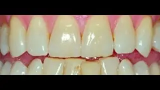 Crest 3d white advanced