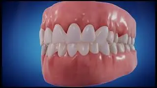 Crooked teeth