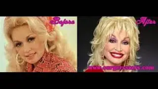 Dolly Parton Before and After Plastic Surgery