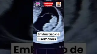 Embarazo de 9 semanas. Latido.