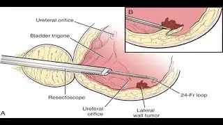 Bladder tumor resection Or transurethral resection of bladder tumor (TURBT) Surgical Procedure