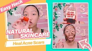 How to Get Rid of Acne Scars 🍅 ( TOMATO SKINCARE HACK )