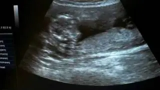 Ultraschall in der 15 SSW It's a Boy