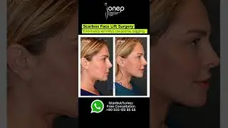 SCARLESS FACE LIFT  NO CUTS OR STITCH MARKS!  #ScarlessFaceLift 💫