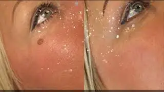 Remove Warts, Moles And Skin Tags With Skincell Pro Reviews   Get Blemish Free Skin Today!!