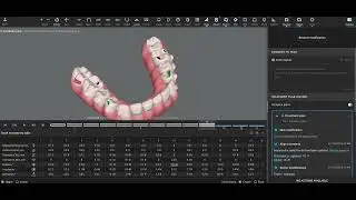 Invisalign Treatment Progress Evaluation - Deep Bite