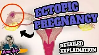 ECTOPIC PREGNANCY | MABUBUNTIS PA BA?