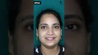 Forehead Lipoma removal surgery #lipomatreatment in Mumbai #osteoma #lipomatreatment
