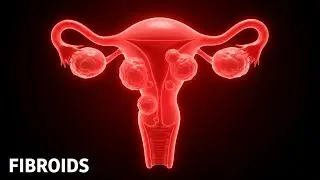 Uterine Fibroids Explained: Symptoms, Causes & Treatment