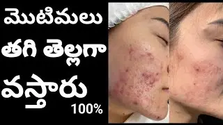 Acne control nd skin whitening treatment - by fair apple