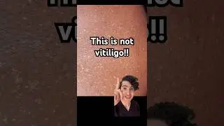 Dermatologist explains white spots on the skin and how they&rsquo;re treated #vitiligo #whitespots