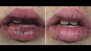 Alex TriVantage Princeton NJ: tattoo removal, brown age spot removal, melasma treatment