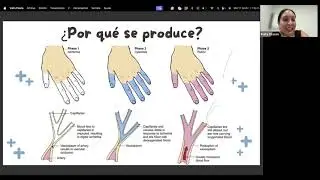 Cómo vivir mejor con Esclerodermia