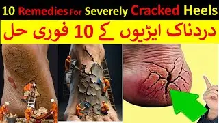 Severely Cracked Heels | Pain, Bleeding & Deep Cracks Treatment | Top 10 Remedies