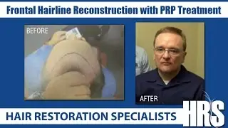 Frontal Hairline Reconstruction with PRP Treatment - Hair Restoration Specialists of Atlanta