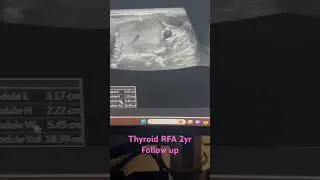 2 YR post Thyroid Radio frequency ablation by Sean Nikravan, MD