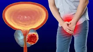 Prostate Cancer: Causes And When To See A Doctor