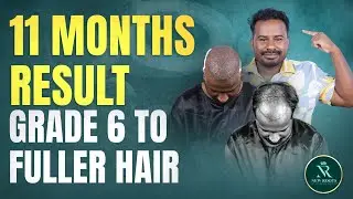 I Tried Hair Transplant in Bangladesh and Got AMAZING Results