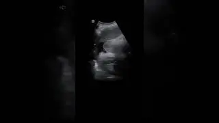 SABER SI ES NI&Ntilde;O O NI&Ntilde;A🤰POR ULTRASONIDO 🐢🍔