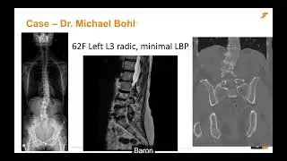 Identifying the Ideal VBO Patient: Clinical Decision Making with Dr. Michael Bohl