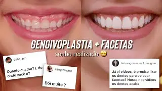 GENGIVOPLASTIA + FACETAS EM RESINA - Quanto custou? Dói? ANTES E DEPOIS