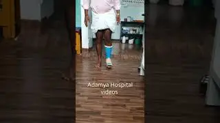 Jone's avulsion fracture | 5th Metatarsal base fracture | Conservative Fiberglass Plstr | Adamya H V