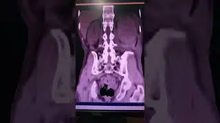 kidney CT Scan axial and coronal orientation