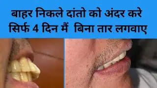 बाहर निकले दांतों का इलाज सिर्फ 4 दिन में बिना तार लगवाए// Smile design//Smile makeover//दाँत//teeth