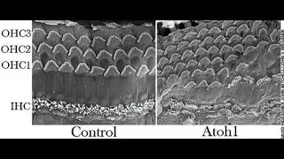 Revolutionary Deafness Treatments - Fox News Special Report - 2015