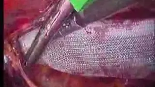 Ten steps of Total Extra Peritoneal (TEP) (by Dr.Parveen Bhatia) Part 5