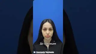 Височный лифтинг.До и 2 недели после операции😯🔥 #ринопластика #ринопластикамосква