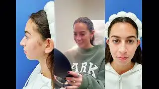 They Couldnt believe their results #Rhinoplasty #Nosejob #Beforeandafter #Results #Reveal