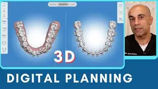 How we Plan Braces Treatment with 3D Digital Planning?
