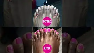 EXCISION OF TOE CORN #cornexcision #toecorns  #cosmeticfootsurgery #bunion #hammertoe #crockedtoes