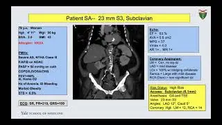 Management of CAD, pre and post TAVR: Guidelines, tips and tricks. Dr John Forrest