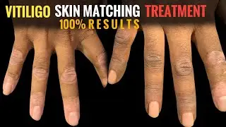 Vitiligo whitepatch coverup tattoo | Organic process | Zero side effects