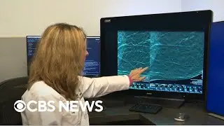 How mammograms can spot hidden signs of heart disease