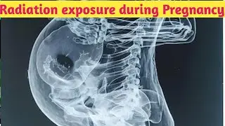 Effects of radiation in pregnancy || Which investigation is safe USG / X ray || Obs & Gynae