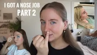 nose job vlog | PART 2 | recovery & cast removal | NEW NOSE REVEAL