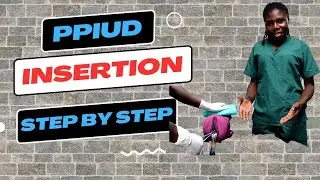 PPIUD INSERTION- Procedure