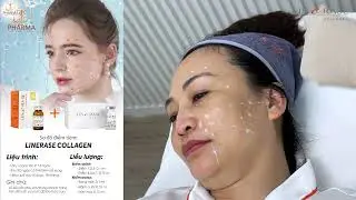 Kỹ thuật ti&ecirc;m điểm Linerase v&ugrave;ng mặt