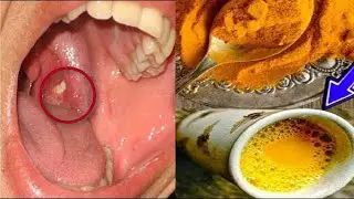 ISSO ACABA COM PODRID&Atilde;O NA GARGANTA E AQUELAS BOLINHAS FEDIDAS -Adeus Dor de Garganta