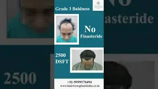 Best Hair Transplant Clinic in Delhi | Best Hair Transplant Surgeon in India | Dr. Shaiil Gupta