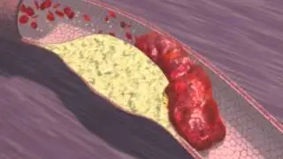 Plaque Rupture