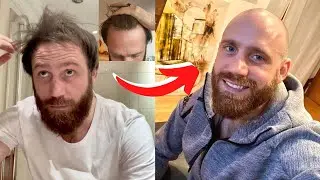 HIDING HAIR LOSS With HAIR FIBRES To Embracing A SHAVED HEAD - TRANSFORMATION
