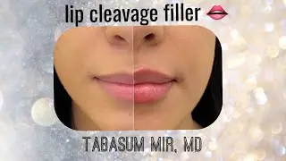 How To create Lip Cleavage with filler