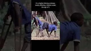 World Polio Day - 24th October