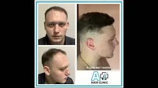 6 MONTHS AFTER HAIR TRANSPLANT WITH DHI (CHOI PEN) TECHNIQUE